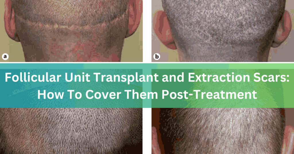 Follicular Unit Transplant and Extraction Scars